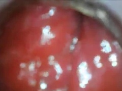 Anal Endoscope Ass Play From Inside
